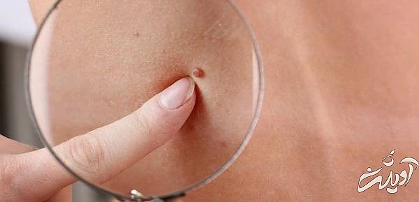 خال روی شکم